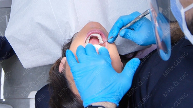 When Veneers Should Be Polished